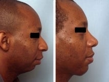 Rhinoplasty