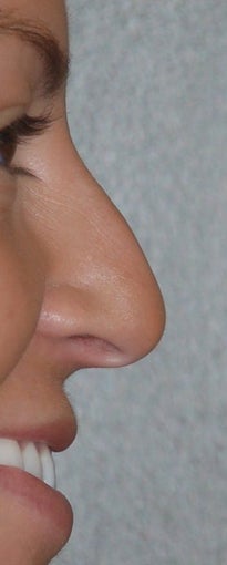 Rhinoplasty - Hump Reduction, Lift Drooping Tip