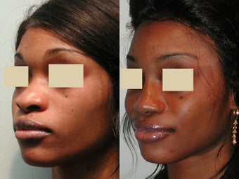 African American Rhinoplasty