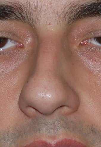 Rhinoplasty, Deviated Septum