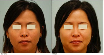 Dallas Asian Rhinoplasty