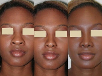African American Rhinoplasty