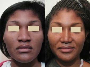African American Rhinoplasty