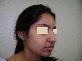 Rhinoplasty