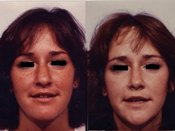 Rhinoplasty