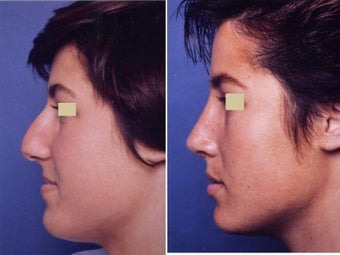 Rhinoplasty