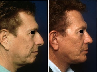 Rhinoplasty, chin implant and facelift