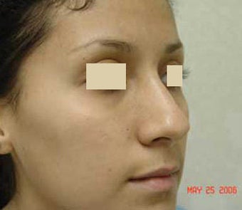 Rhinoplasty