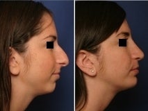 Rhinoplasty and chin implant