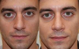 Rhinoplasty, 6 weeks post-op. 