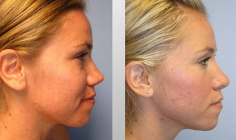 Rhinoplasty