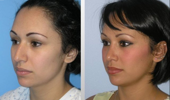 Rhinoplasty