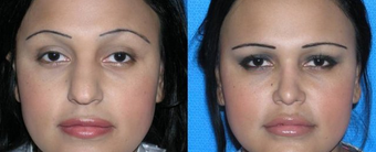 Rhinoplasty