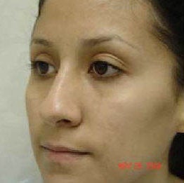 Rhinoplasty