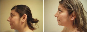 Rhinoplasty