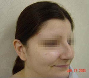 Rhinoplasty