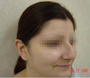 Rhinoplasty