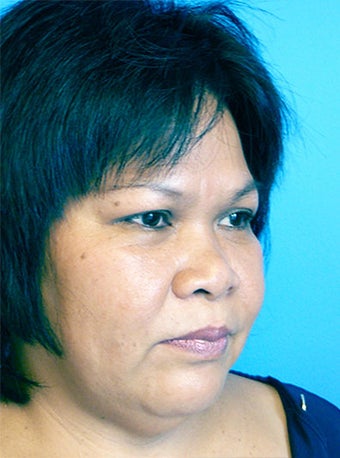 Rhinoplasty