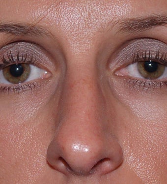 Open Rhinoplasty
