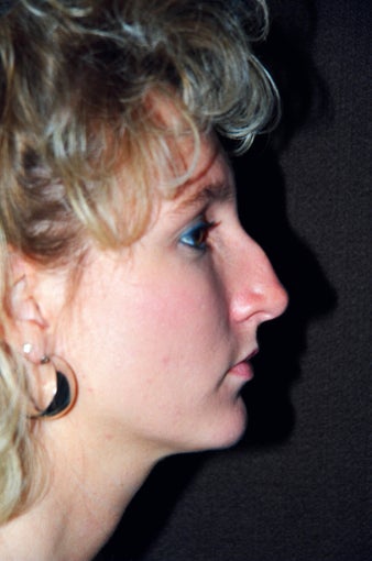 Rhinoplasty (nose job)