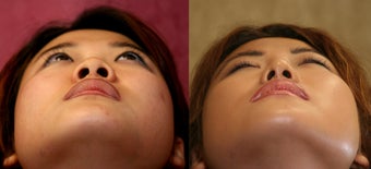 rhinoplasty- asian
