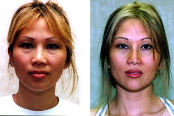 Rhinoplasty- Asian