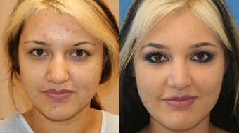 Natural Rhinoplasty 