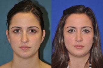 Rhinoplasty