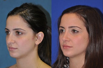 Rhinoplasty