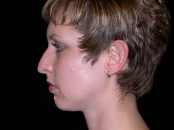 Rhinoplasty and Chin Implants