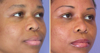 Nose reshaping