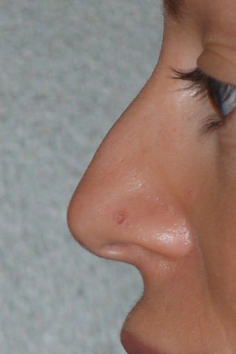 Rhinoplasty