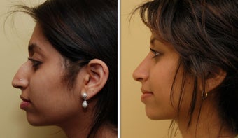 Ethnic Rhinoplasty