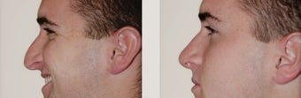 Primary Rhinoplasty