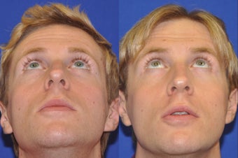 Endonasal Rhinoplasty