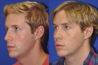 Endonasal Rhinoplasty