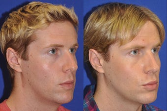 Endonasal Rhinoplasty