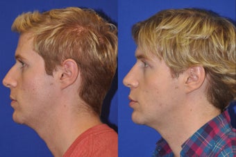 Endonasal Rhinoplasty