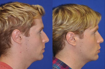 Endonasal Rhinoplasty