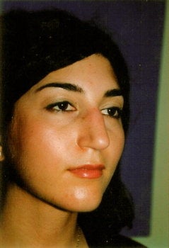 Rhinoplasty