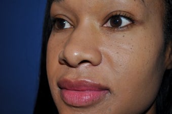 33 year-old female Rhinoplasty