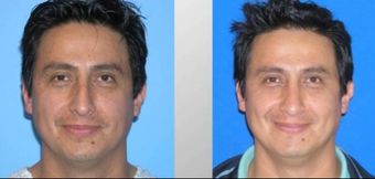 Rhinoplasty