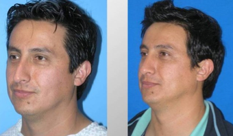 Rhinoplasty