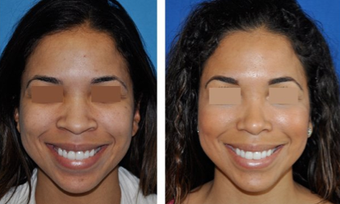 Rhinoplasty