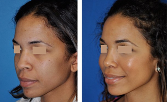  Rhinoplasty