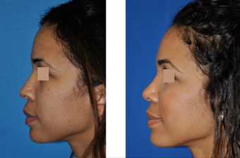 Rhinoplasty