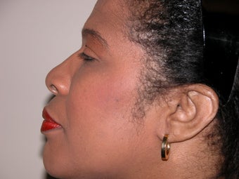 Rhinoplasty