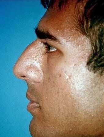 Rhinoplasty
