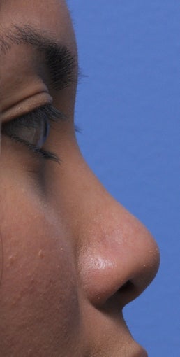 Non Surgical Rhinoplasty