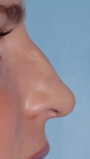 Non Surgical Rhinoplasty